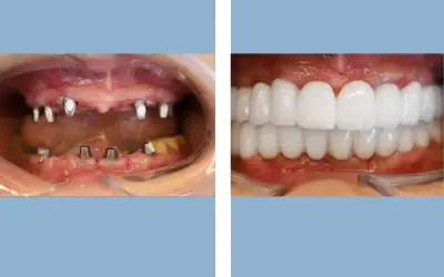 Before and After